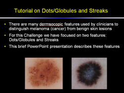 Globules and Streaks Tutorial