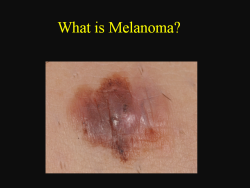 Melanoma Tutorial